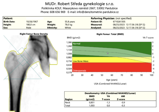 DXA_femur blind.png